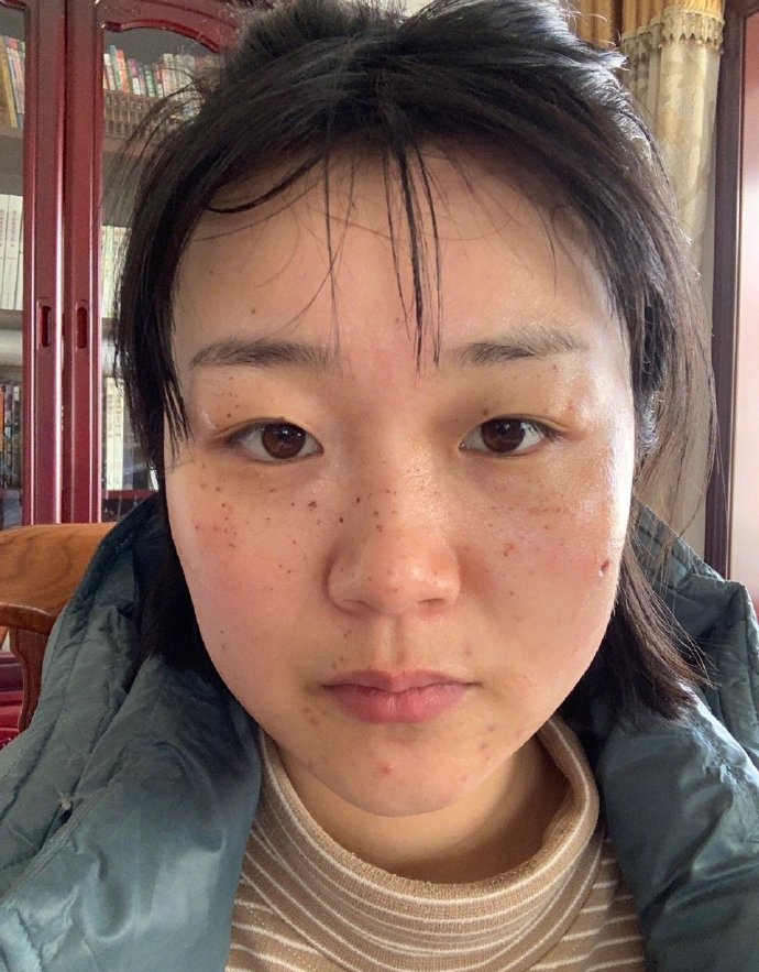 植題真實祛斑成功案例