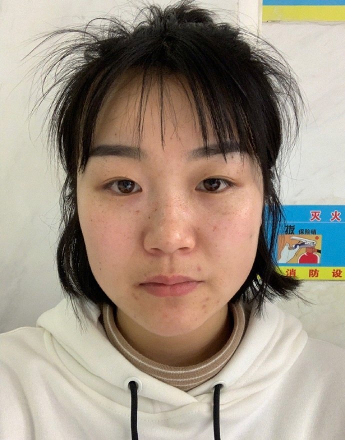植題真實祛斑成功案例