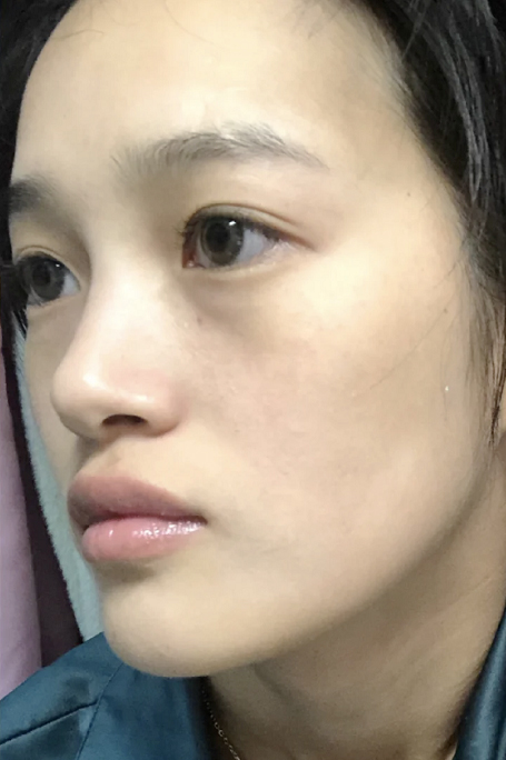 植題祛斑美白後